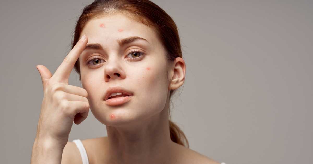 Is Egg And Cinnamon Good For Acne? Talk Leisure