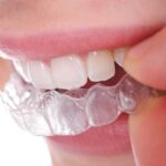 Can you drink coffee with retainers?