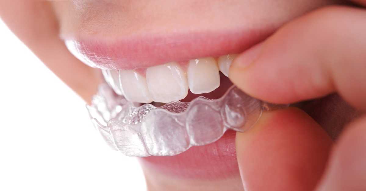 Can You Drink Coffee With Retainers? Talk Leisure