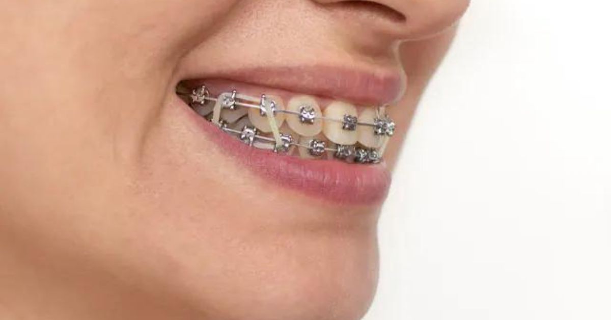 Do You Take Off Your Rubber Bands When You Sleep? Read This to Find Out