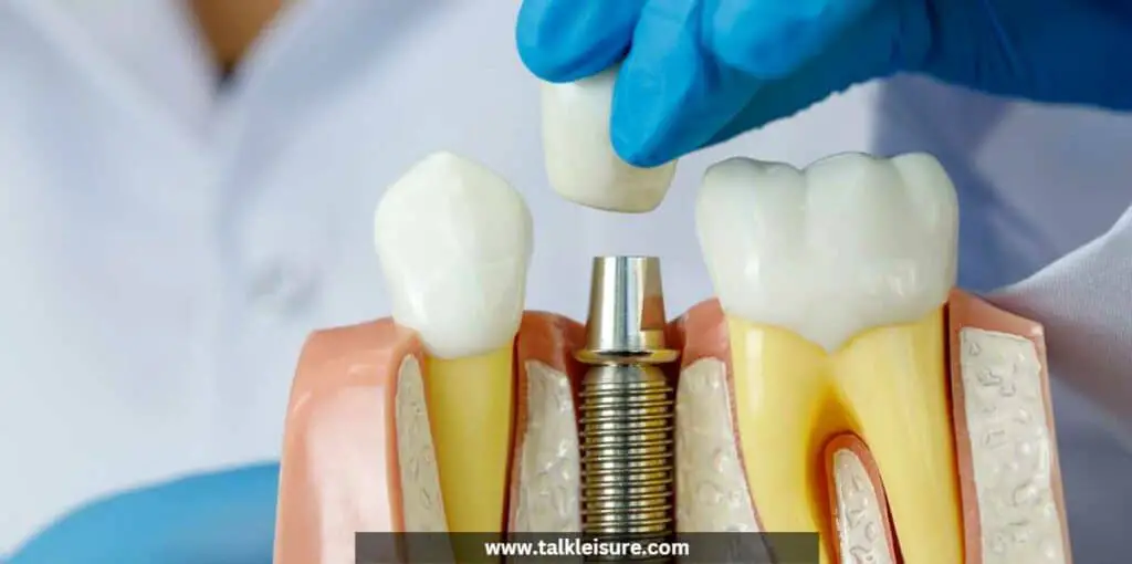 How To Save Money On Dental Implants