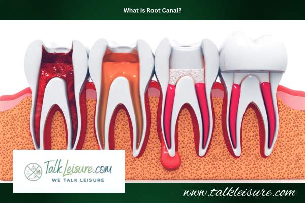 What Is A Root Canal?